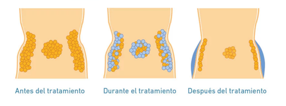 Efectos del tratamiento con Polarys Plaxx
